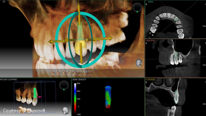 Ez3D-i dental software for 3D diagnostic imaging (Ewoosoft)