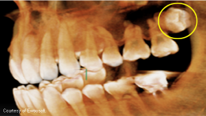 Ez3D-i dental software for 3D diagnostic imaging (Ewoosoft)