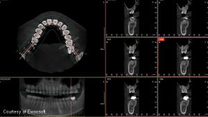 Ez3D-i dental software for 3D diagnostic imaging (Ewoosoft)