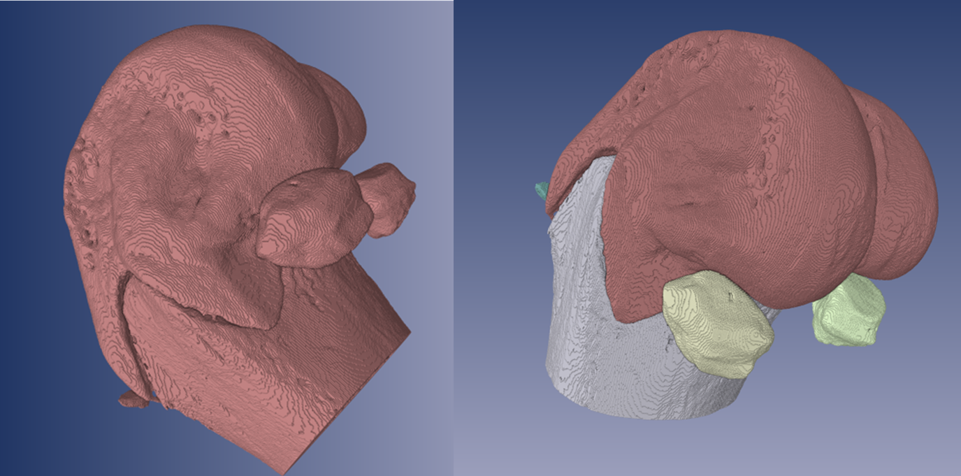 A. Behrooz, and P. Kask, Systems and Methods for Automated Segmentation of Individual Skeletal Bones in 3D Anatomical Images, US Patent Application No. 14/812,483 (July 2015).