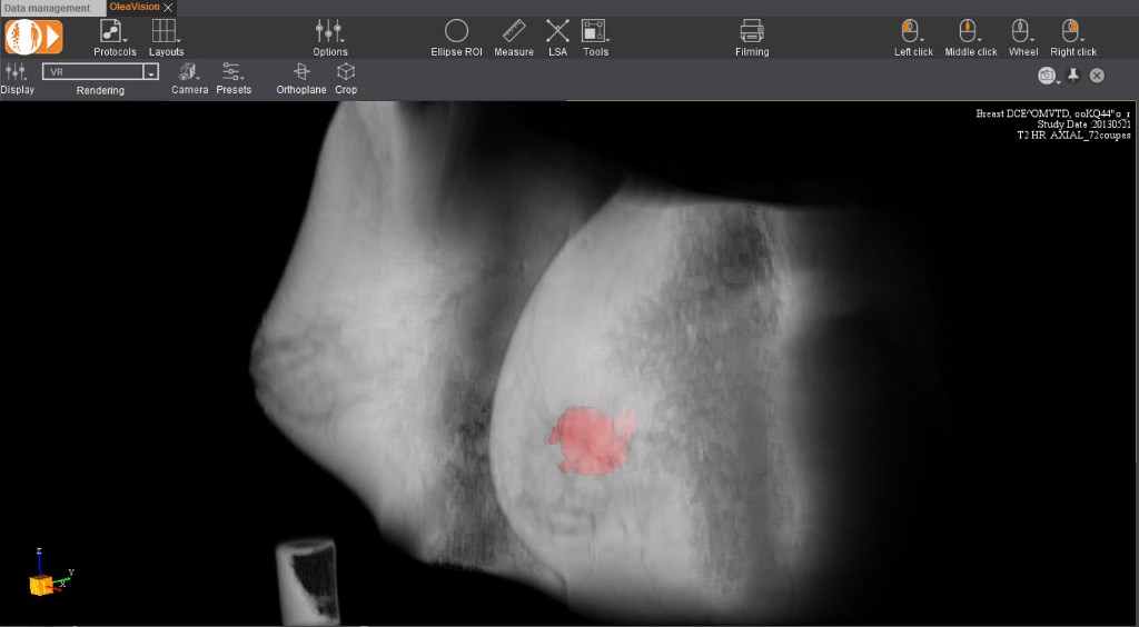 Open-Inventor-3D-Toolkit-Medical_Olea-Medical_Breast-Lesion-3D