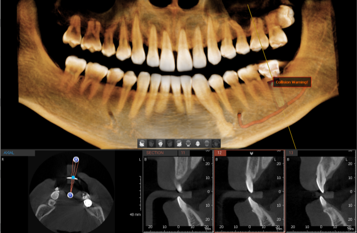 Ez3Di, dental software for 3D diagnostic imaging (Ewoosoft) Open