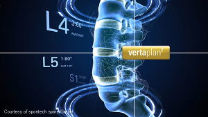 vertaplan planning software for spine treatment (spontech)