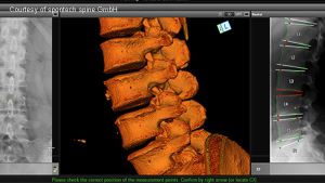 vertaplan planning software for spine treatment (spontech)