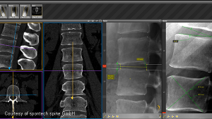 vertaplan planning software for spine treatment (spontech)