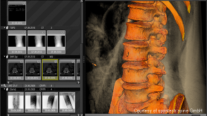 vertaplan planning software for spine treatment (spontech)