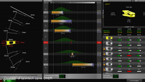 vertaplan planning software for spine treatment (spontech)