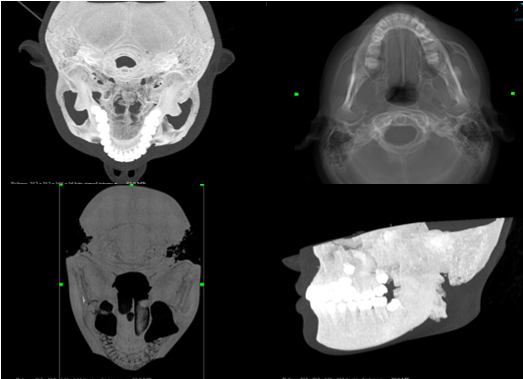 Min, Max & Average intensity projection