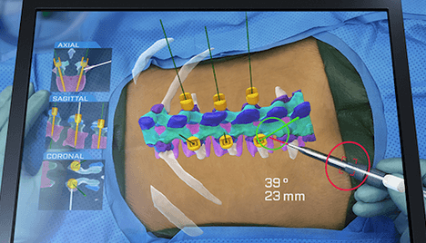 Holosurgical uses Open Inventor for assisted surgery using AR