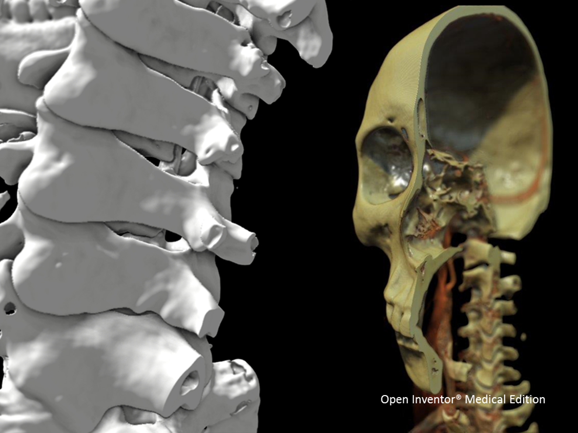 Open Inventor Medical toolkit - realistic 3D rendering