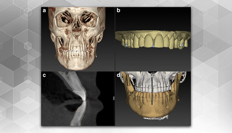 Open Inventor used for 3D visualization in Orthodontics