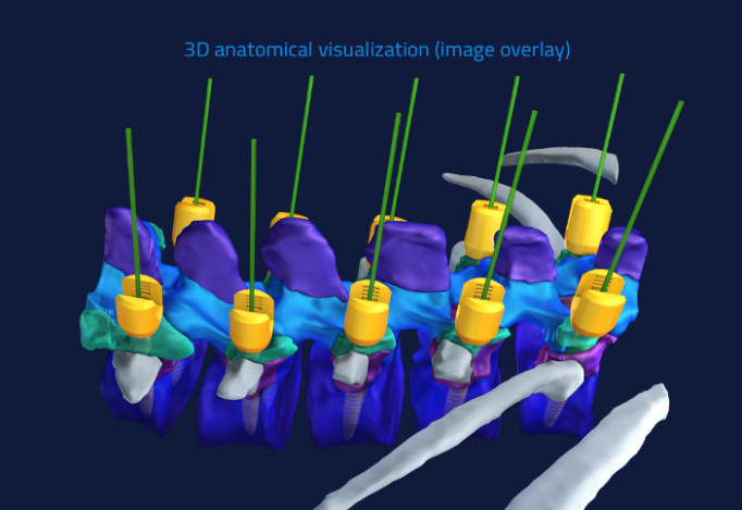 ARAI: Advanced surgical navigation guidance platform (HOLOSURGICAL) uses Open Inventor Toolkit