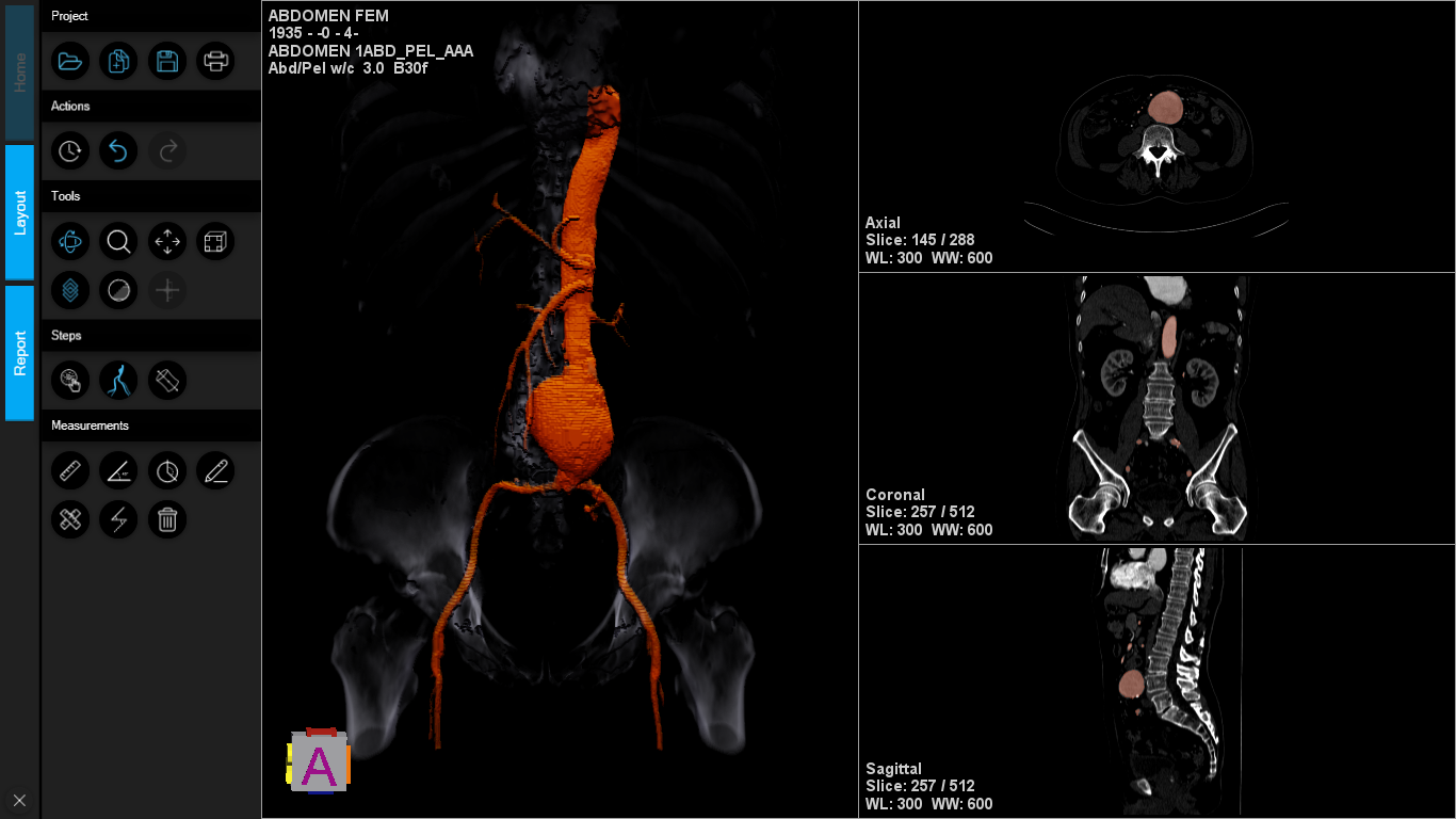 Vessels isolated with one-two clicks segmentation