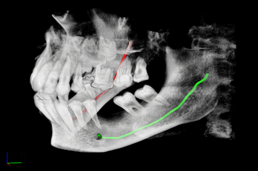 Nerve Marking